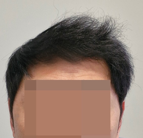 비절개모발이식 다나성형외과 5000모 대량 1년