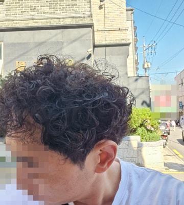 비절개모발이식 다나성형외과 13개월차 후기입니다