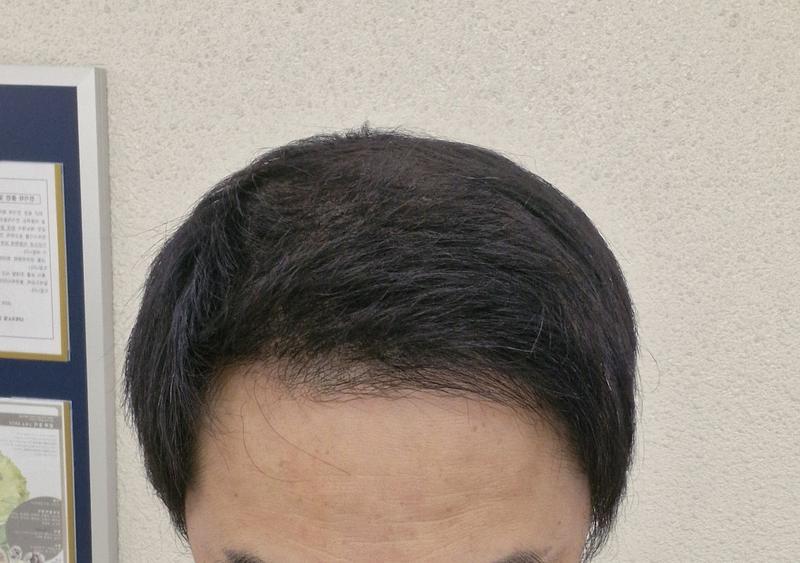ダナ/2500毛包/大量移植/非切開毛髪移植/7ヶ月