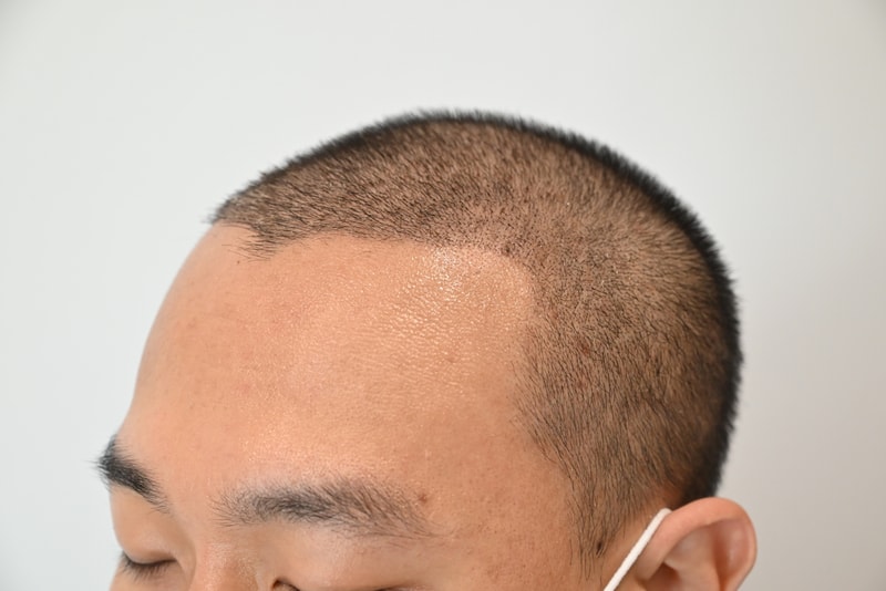 2주경과측면.jpg