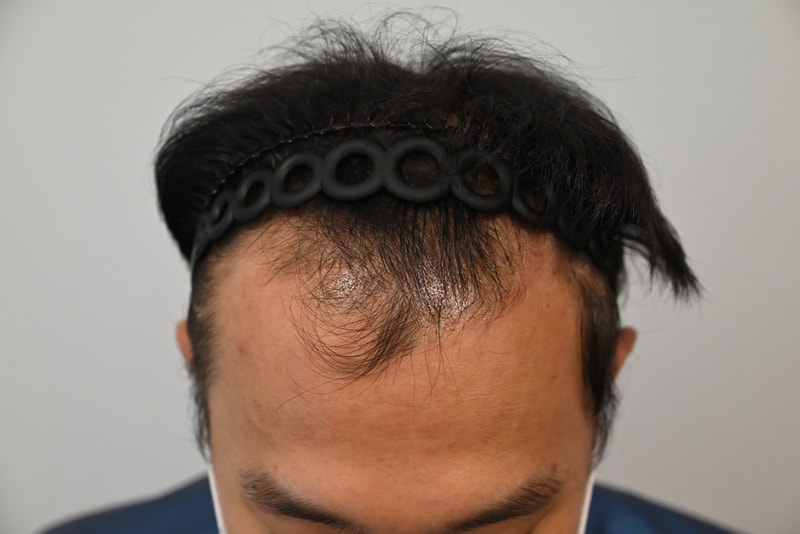 수술전사진입니다..jpg