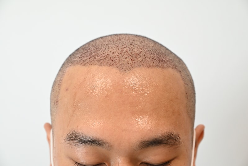 수술 이후 1일 경과샴푸후.jpg