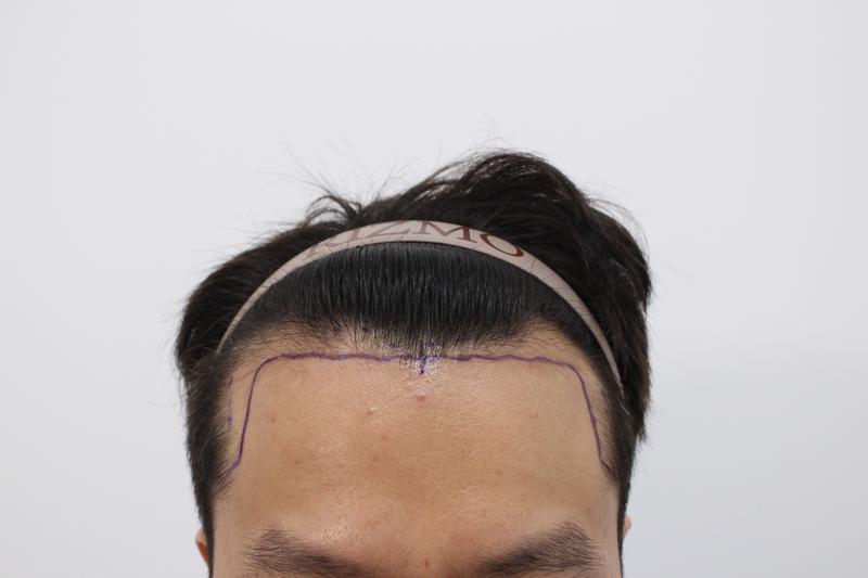 부산리즈모의원 모발이식 12개월 경과 후기