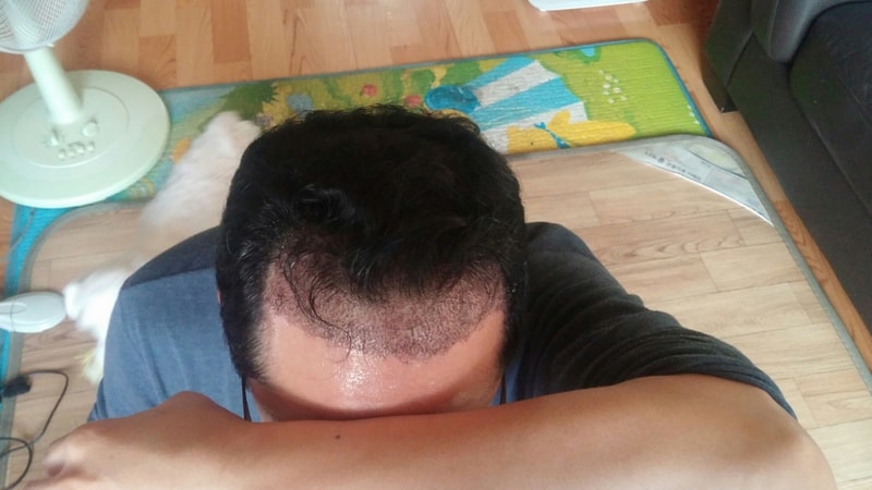 ソウルフォーヘア江南店 5月10日 非切開 1800毛包 部分削髪 手術後のレビュー