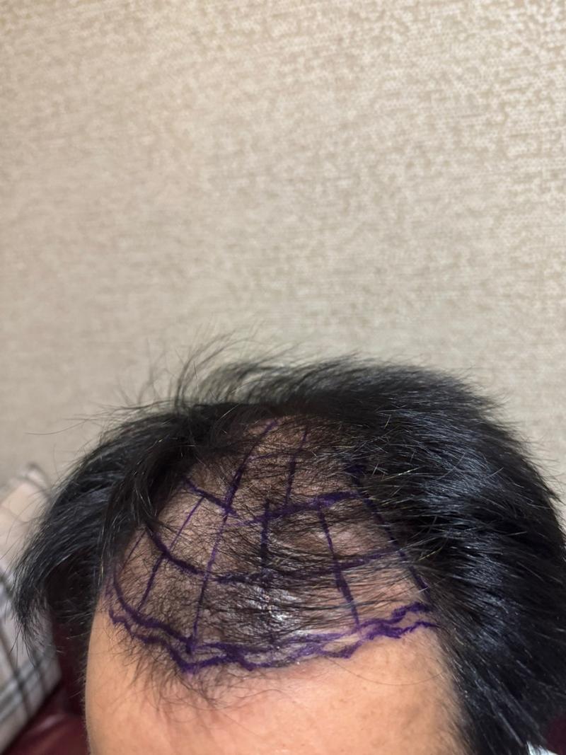New Hair Seoul branch hair transplant 2500 hair follicles 3 months later