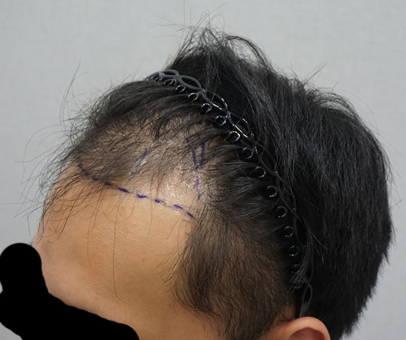 3_수술전디자인.jpg