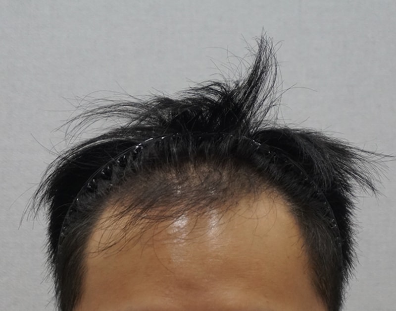 모플러스 성형외과 절개 3200모 후기