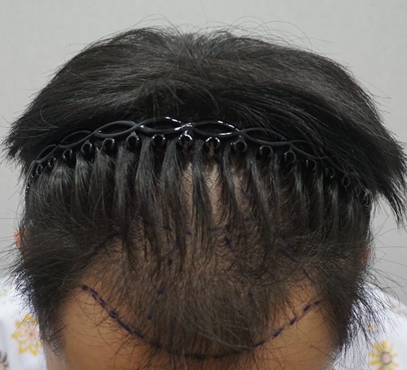 4_수술전디자인.jpg