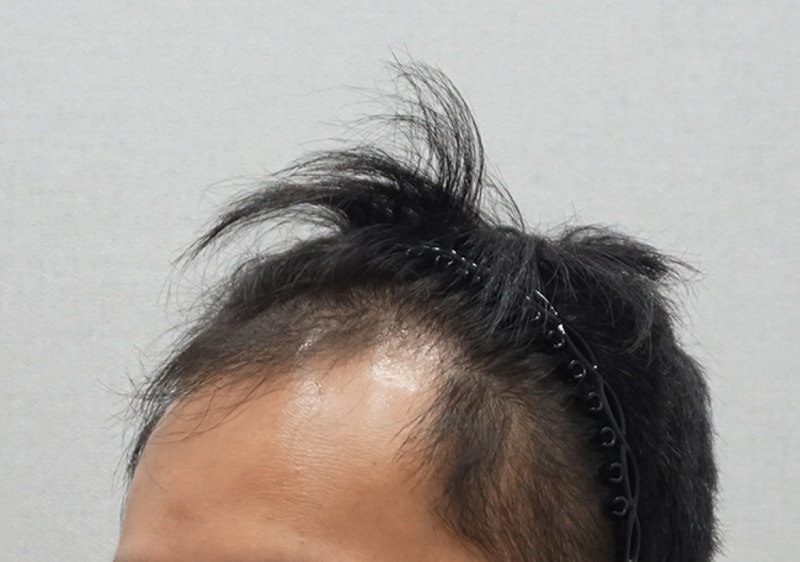 2_수술전측면.jpg