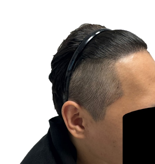 모발이식잘하는곳가면 살찝니다 다나 비절개 14개월