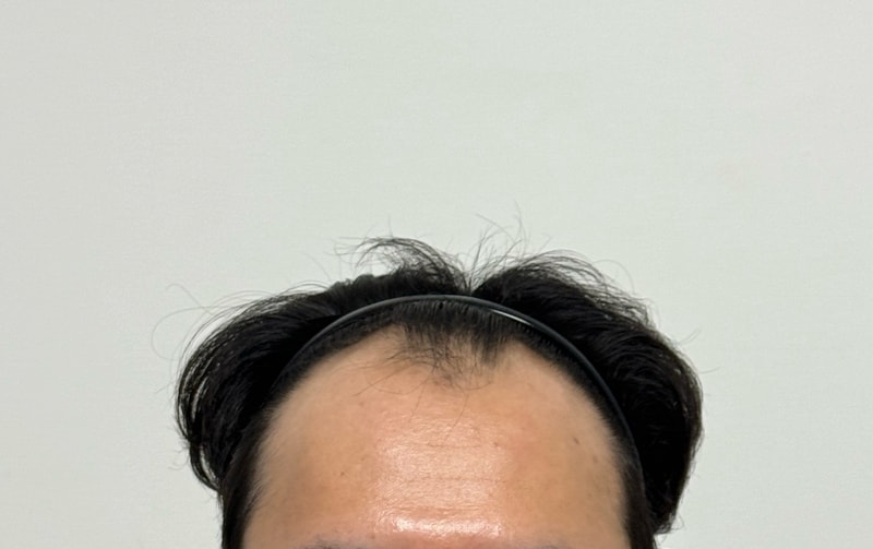Dana Plastic Surgery Non-Sectional Hair Transplantation 6 months I also have a bang..