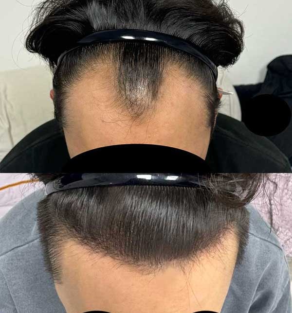 이식전후.jpg