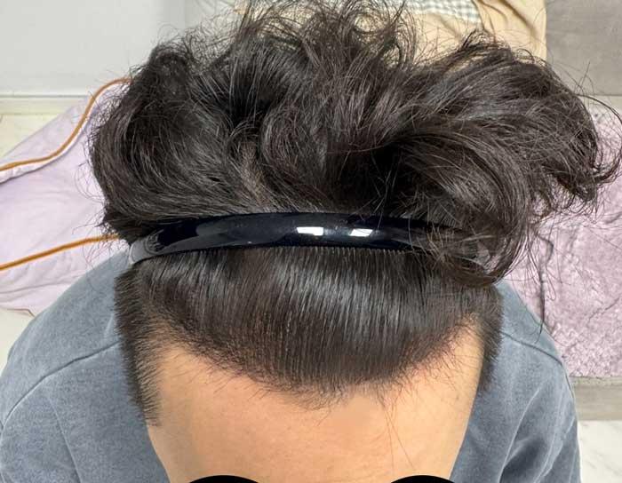 11 months of non-cutaneous hair transplant Dana plastic surgery.. Surgical effect is the best