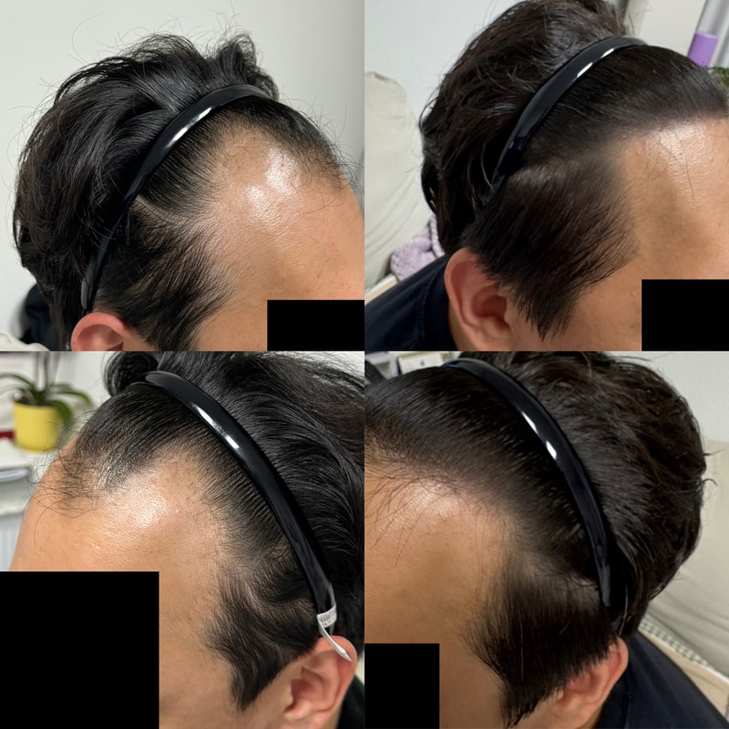 13 months of M-shaped hair loss Dana plastic surgery Non-cut hair transplant