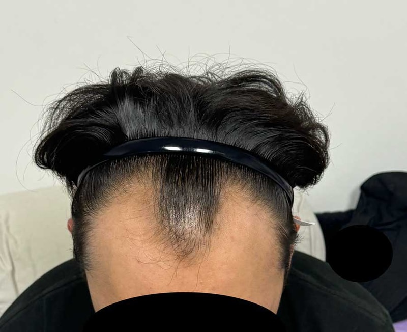 전_이식전.jpg
