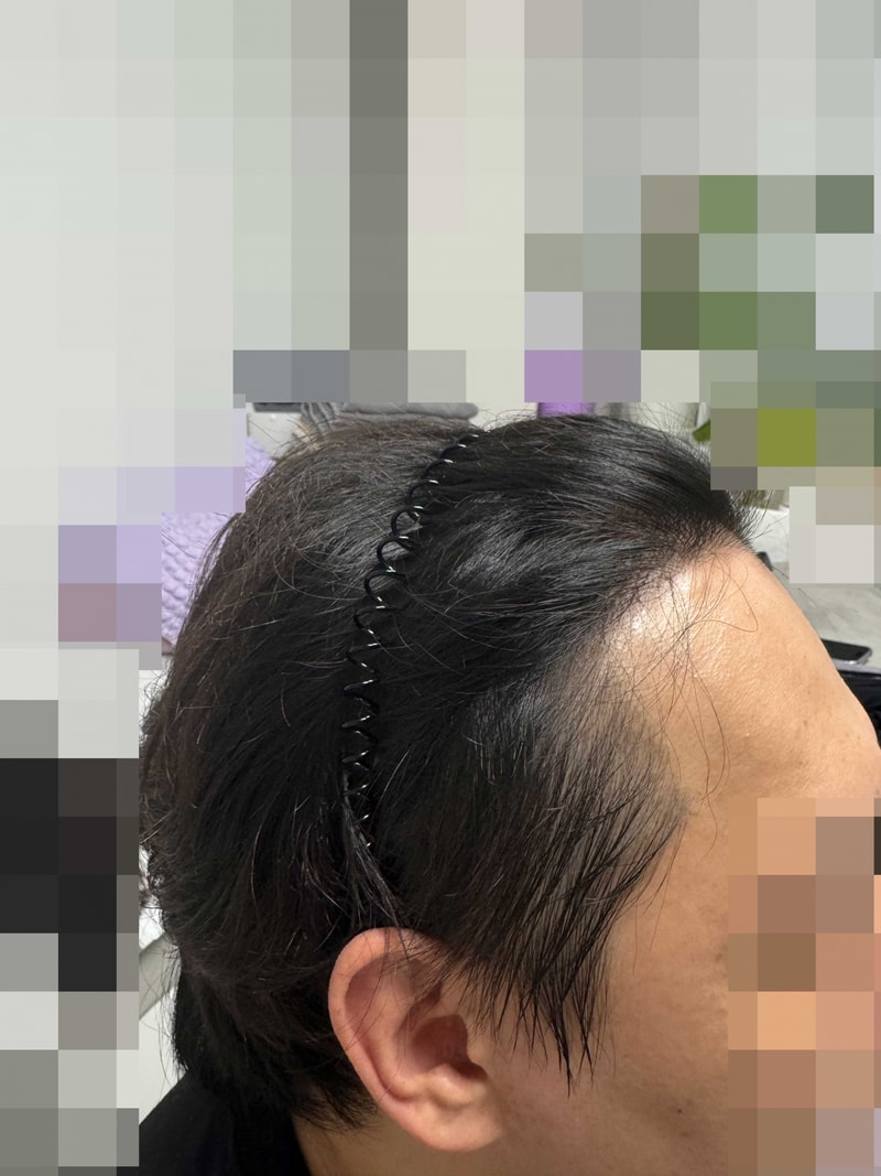 다나, 비절개모발이식 3400모 18개월 후기