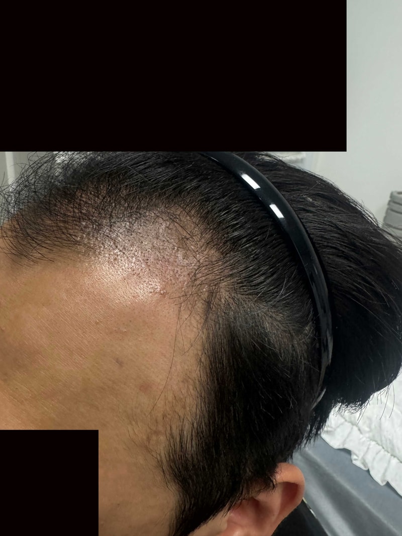 다나성형외과 3400모 비절개 17개월차, 수술vs탈모관리 현실적인방법 추천