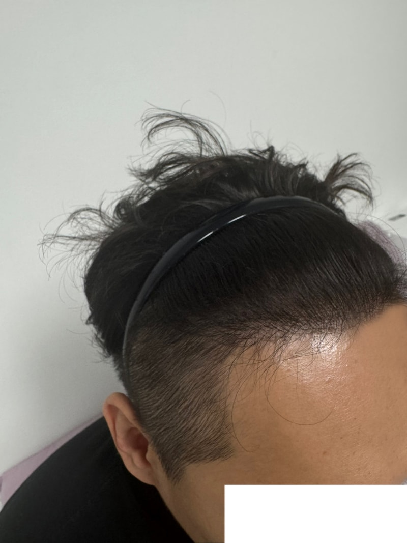 비절개모발이식 다나성형외과 3400모 15개월 후기