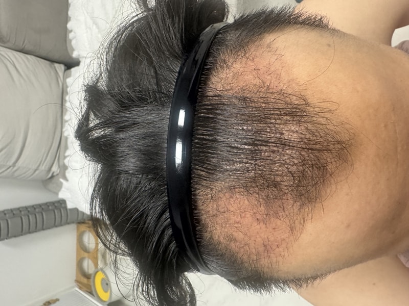 However, a month after the severe m-shaped hair transplant