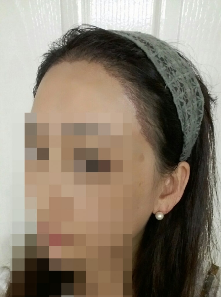 비절개 12일 된 모습이에요