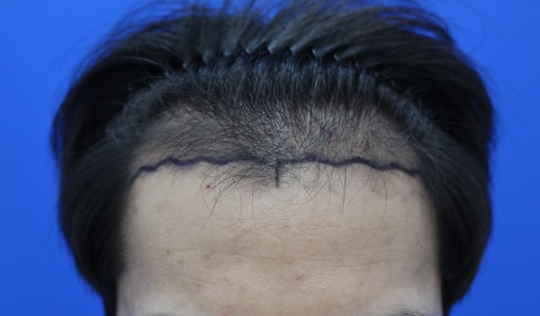 Non-cut 2473 Mo reports the results after a year.