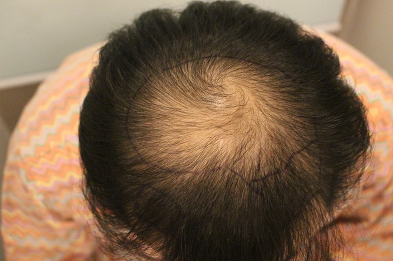 It's 7 months after the top of the head hair transplant.