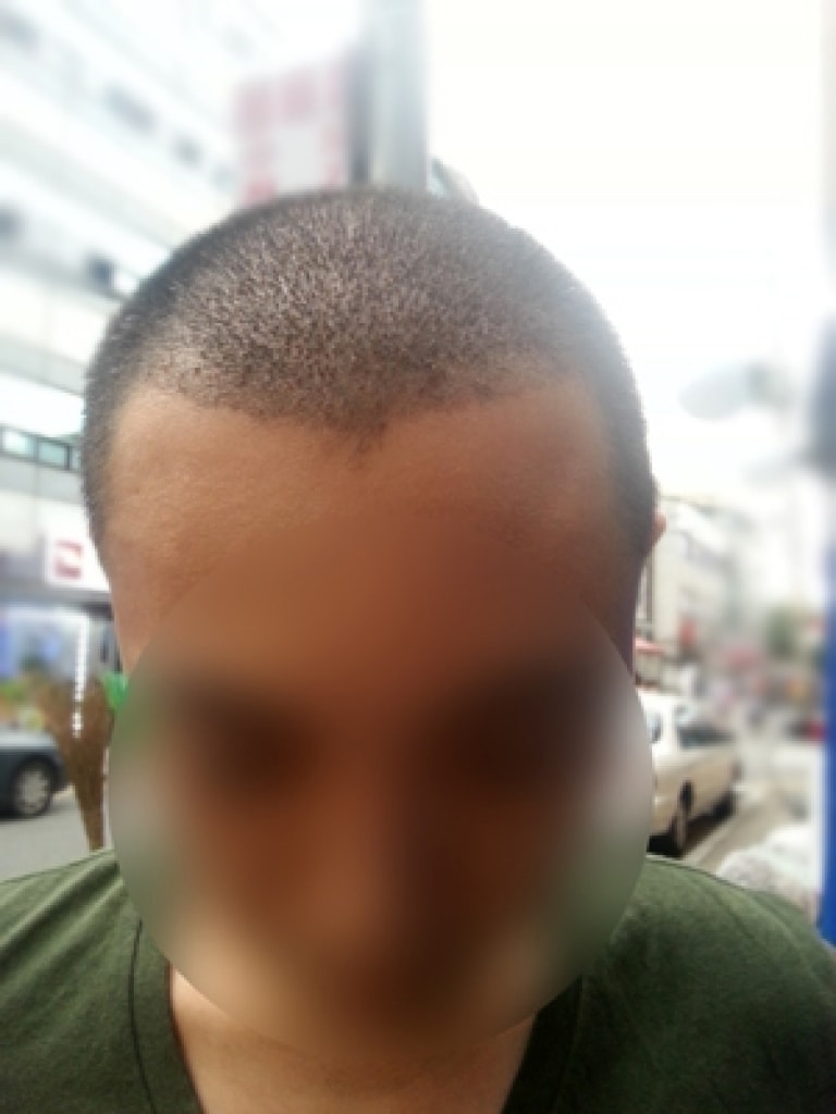 비절개로 2900모낭 다나성형외과 10일째입니다