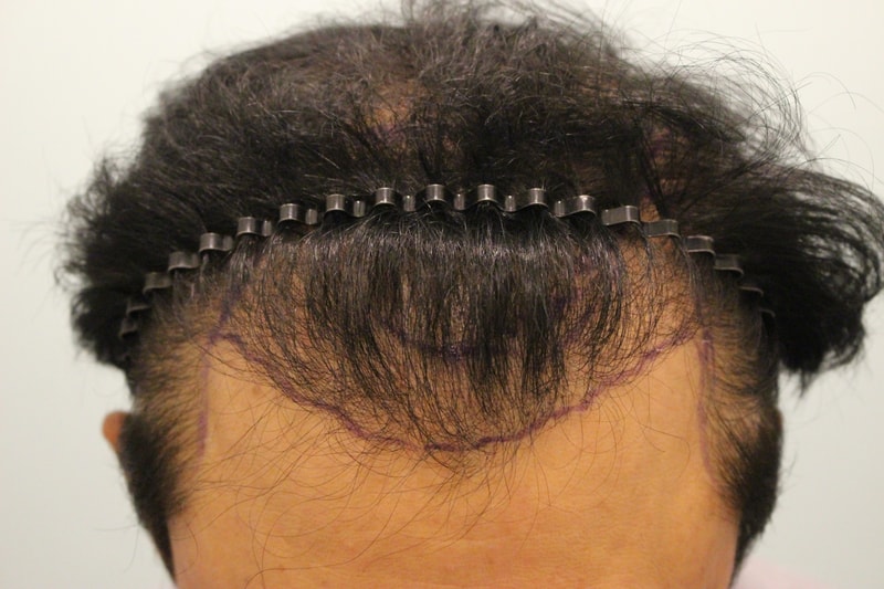 Re-surgery, top of the head, 2 years after hairline surgery