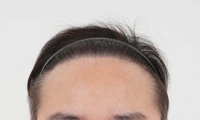 I had 3,000 hair surgery in MOMO HAIR TRANSPLANT, Daegu, and left a review a year later.