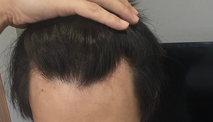 모플러스 성형외과 비절개 2700모(무삭발 500모) 모발이식 후기