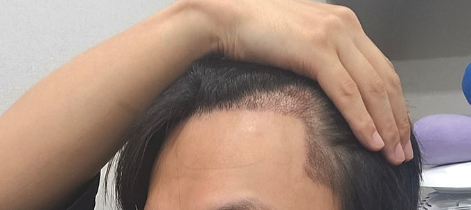 3- 저는 12일차부터 좀씩 빠지기 시작했는데 원장님 뵙고 말씀드리니 자연스러운 현상이니 걱정말라고 하셨습니다.jpg