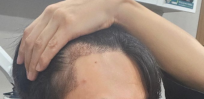 4- 잘심어졌으니 잘빠지고 다시 잘자라주길 지문샴푸받고 많이 더 빠진 느낌.jpg