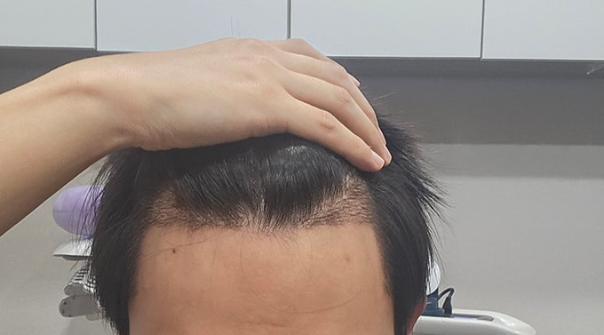 2- 금일 10시 2주샴푸 받고 찍어봤습니 지문샴푸 빡빡해주시고 레이저받았어요.jpg