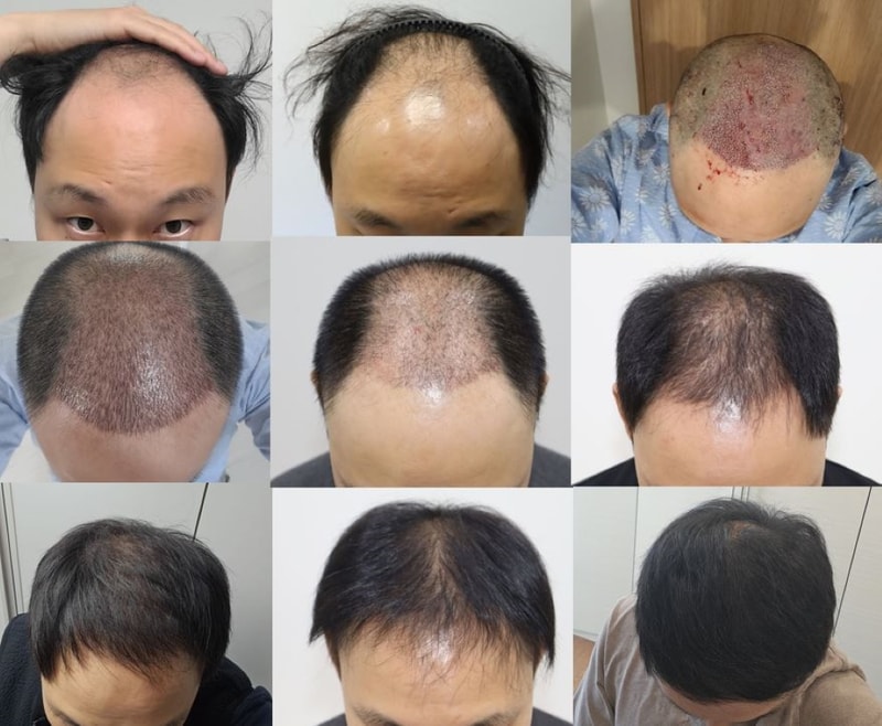 모발이식.JPG
