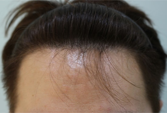 About 4 years after surgery. Maintenance review