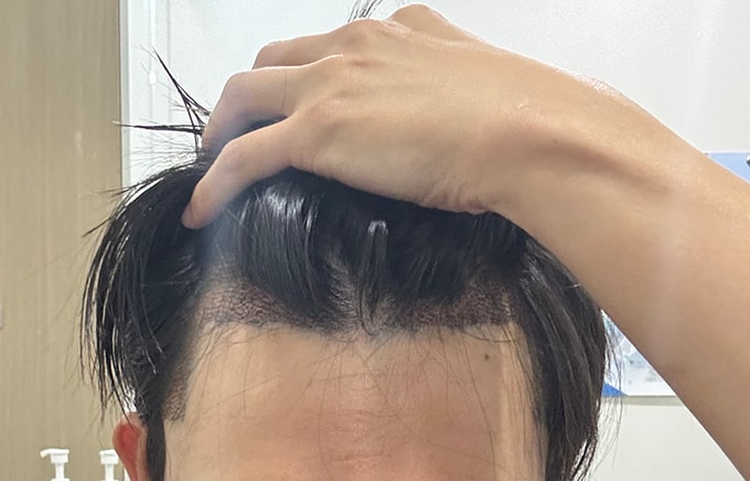 5. 다음날 호텔퇴실하고 바로 병원가서 샴푸받고 찍은 사진입니다 샴푸받고 혼자 머리말리는데 꽤 올래걸렸어요.jpg
