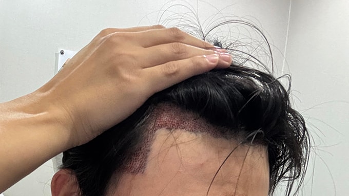 3. 수술끝나고 비니 쓰기 전에 찍어봤어요.jpg