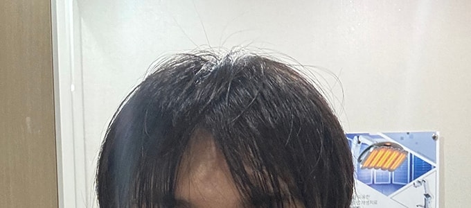 7. 이식한지 하루차라 소중한 이식모들 잘못될까봐 앞머리는 바짝 못말리겠더라구요 대충 이정도 말리고 설명 듣고 귀가했습니다.jpg