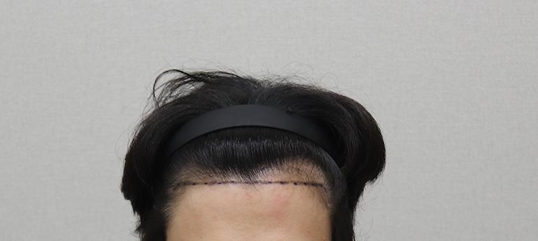 모플러스 모발이식 비절개 2000모 6개월차 후기