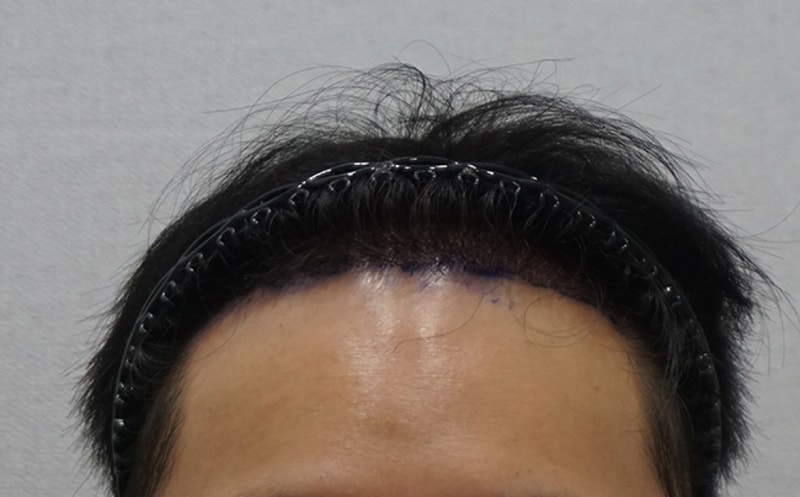 8_수술다음날.jpg
