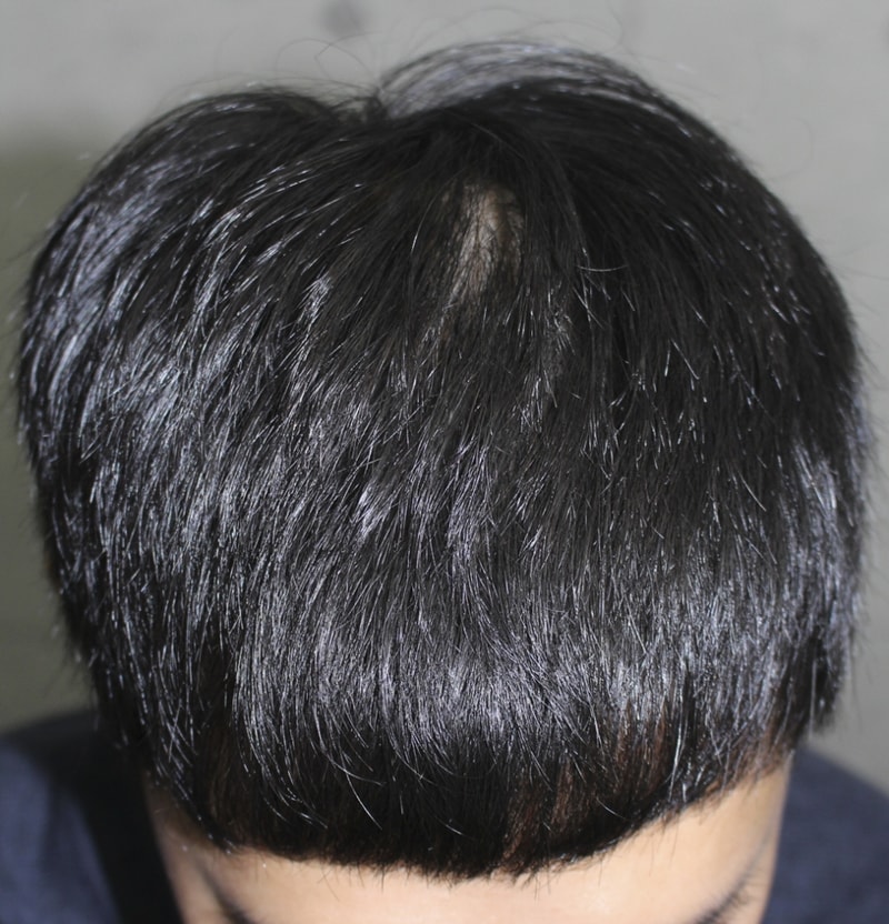 ハンナイブから切開 3700本 8ヵ月になりました