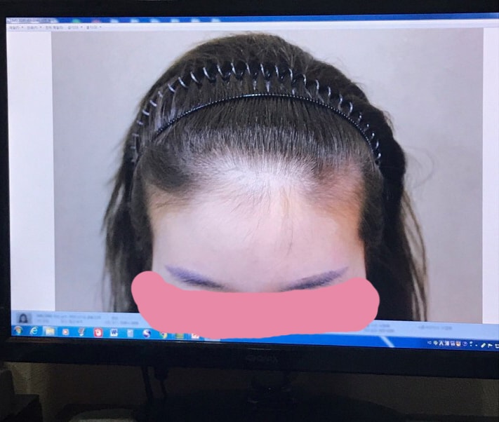 헤어라인+눈썹이식 2년8개월차 리얼 후기! 절개 2500