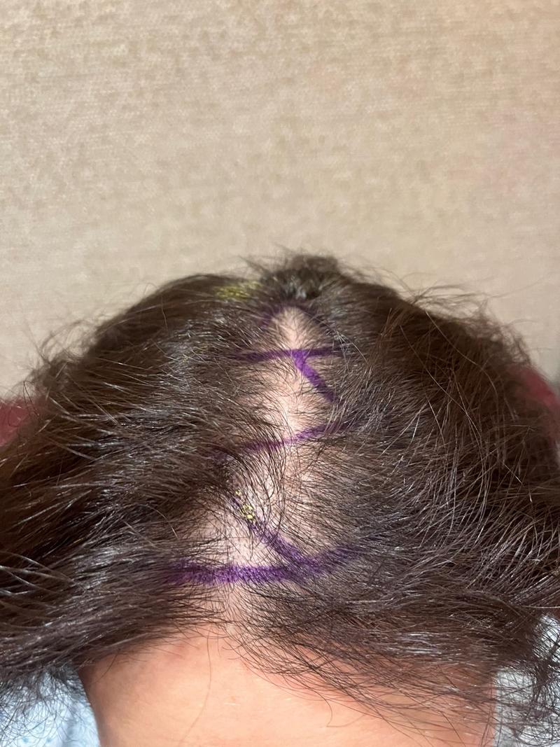 [New Hair] 接缝 毛发移植 1800 毛囊 8个月后期