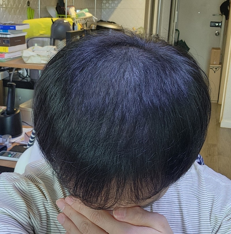 모발이식_3개월차.jpg