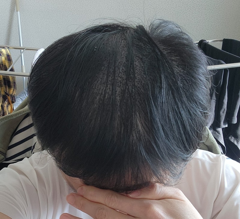 모발이식_7일차.jpg