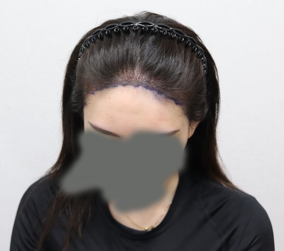 수술후2.jpg