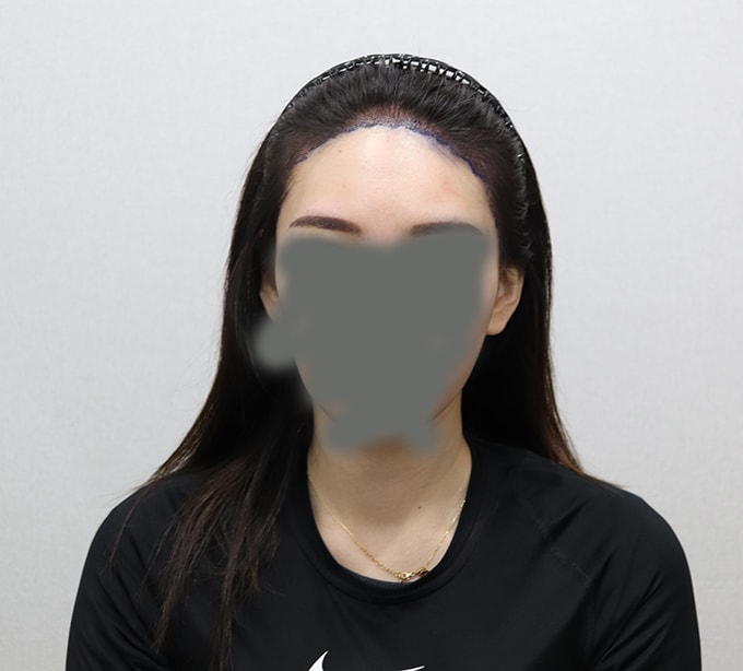 수술후1.jpg