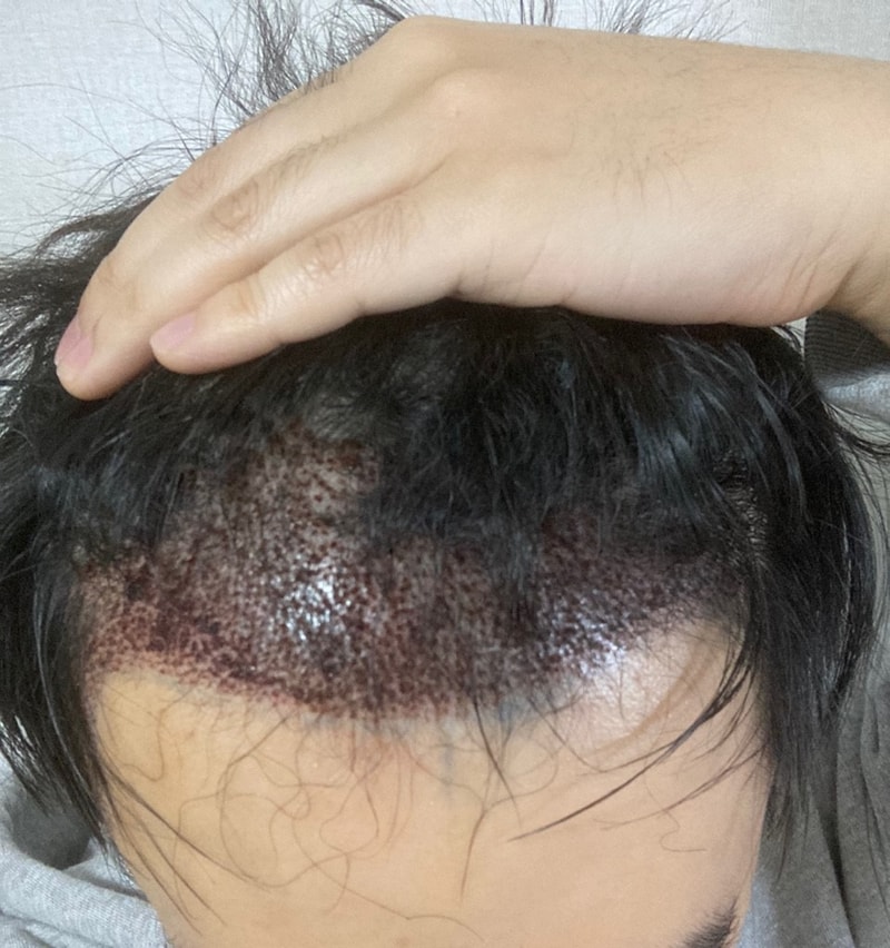 Dana's 1 year and 3 months post-mortem non-cut hair transplant