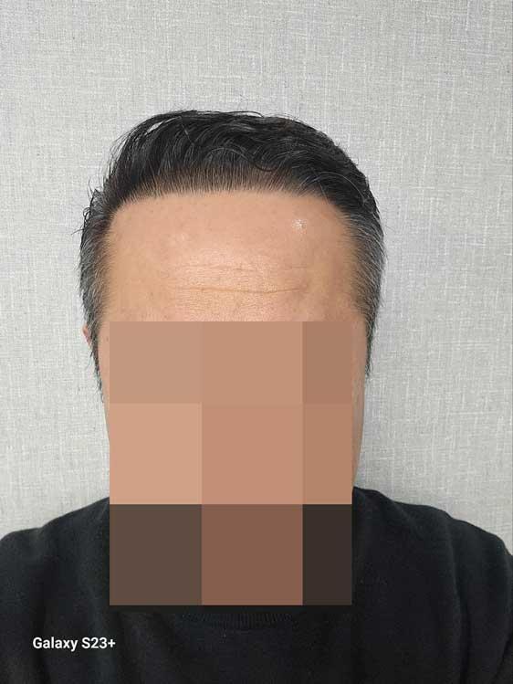 다나성형외과 비절개모발이식 6000모 10달~~~