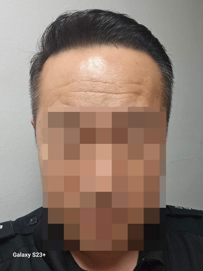 다나성형외과에서 대량이식으로 되찾은 청춘~~ 1년차~~^^